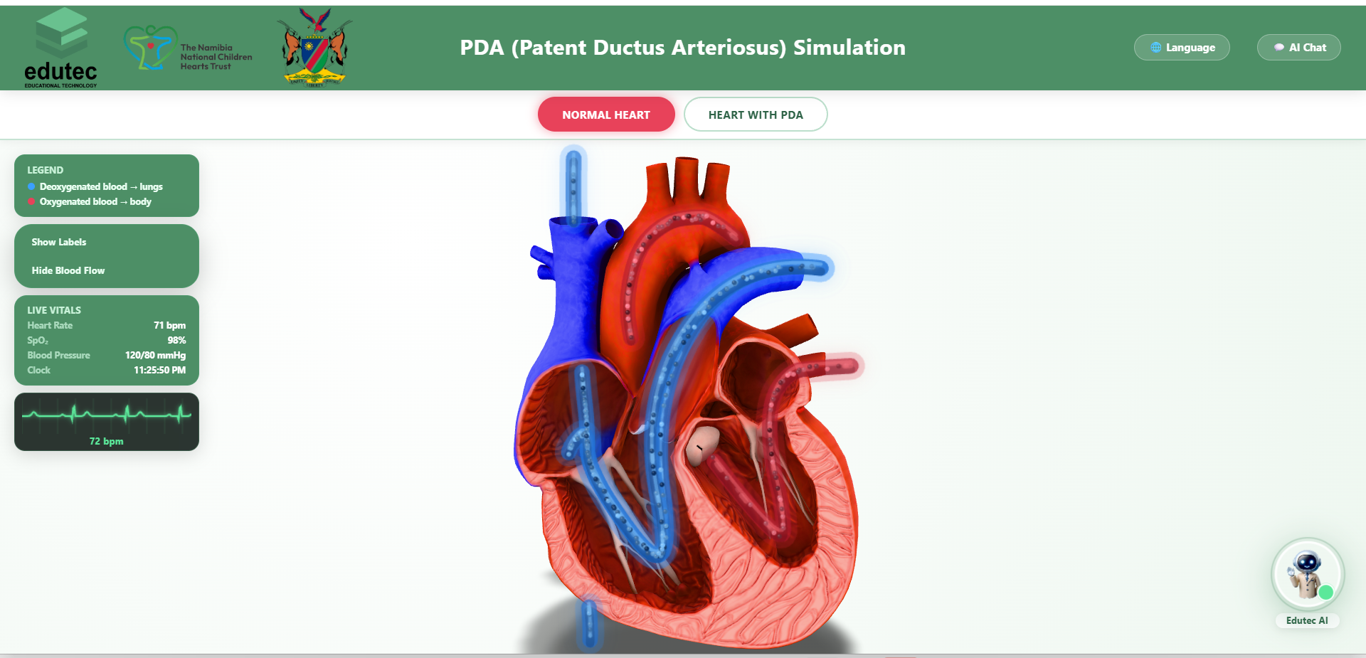 Transposition of the Great Arteries Simulation