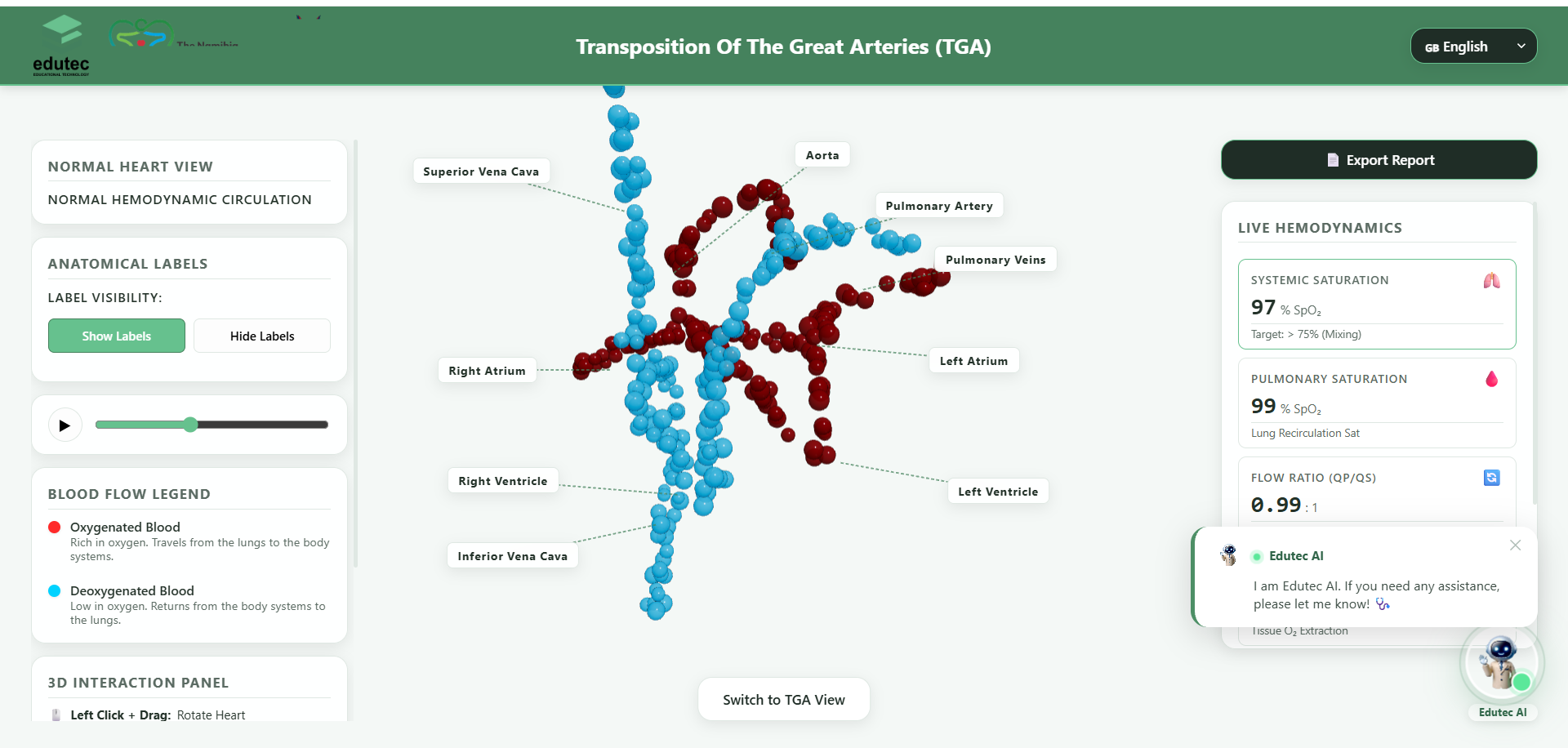 Transposition of the Great Arteries (TGA) Simulation